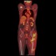 Osteolytic metastasis, pathological fracture of femur, osteosynthesis: NM - Nuclear medicine